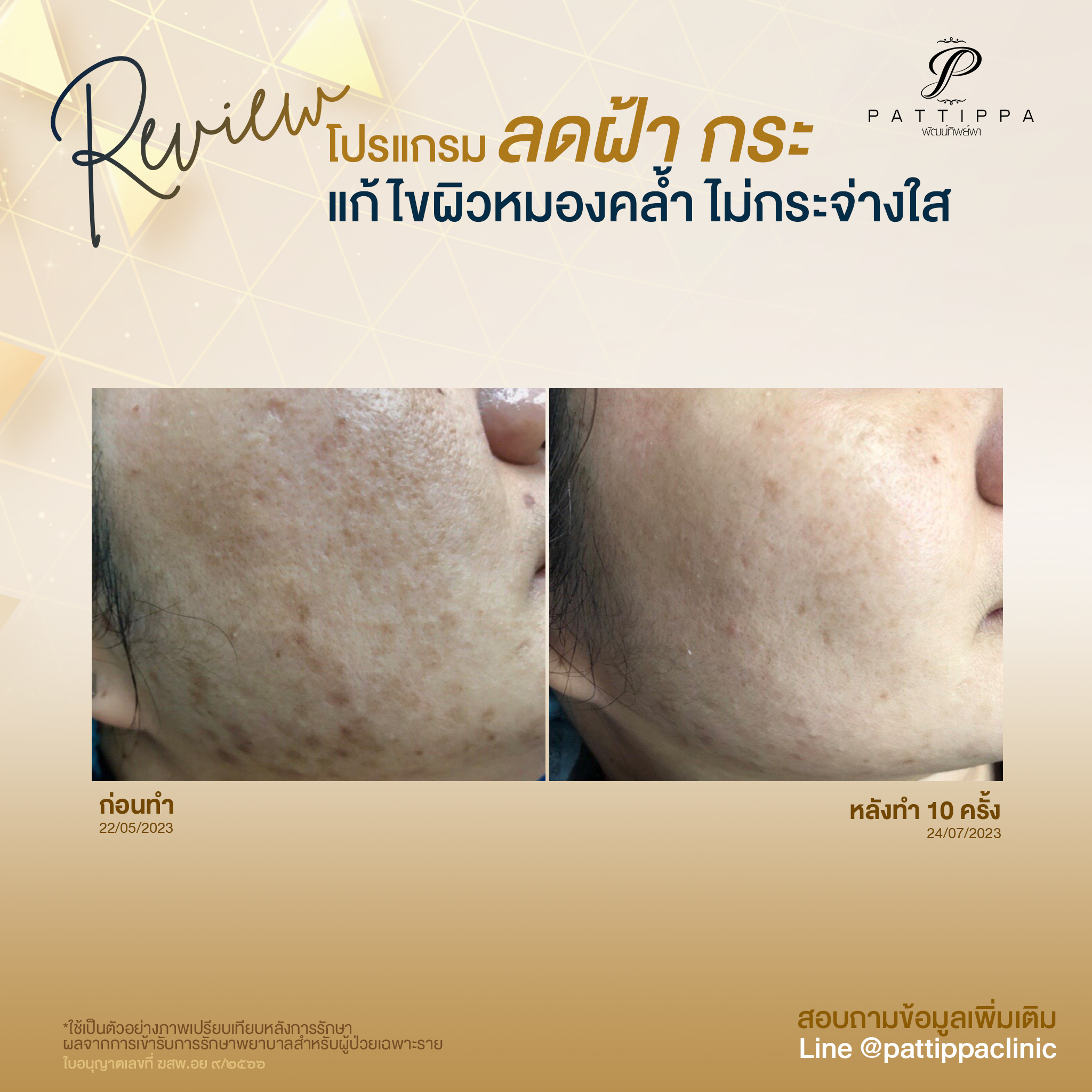 Patt_review_melasma_008-6