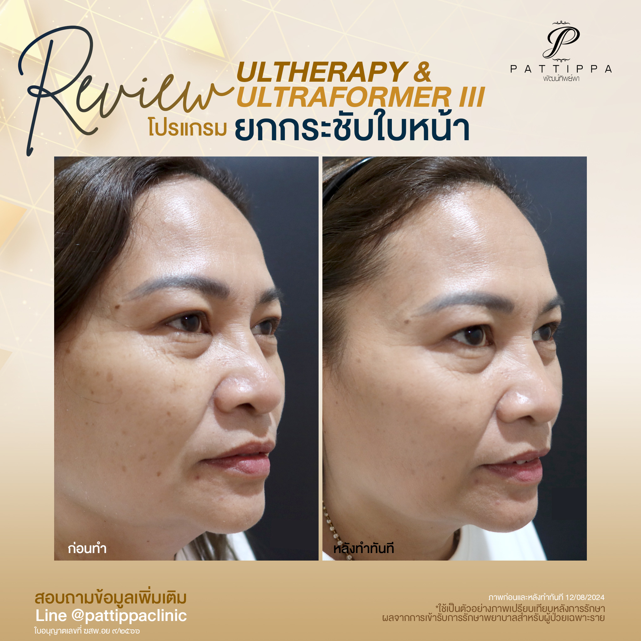 Patt_review_ultherapy+ultraformer3_002-1