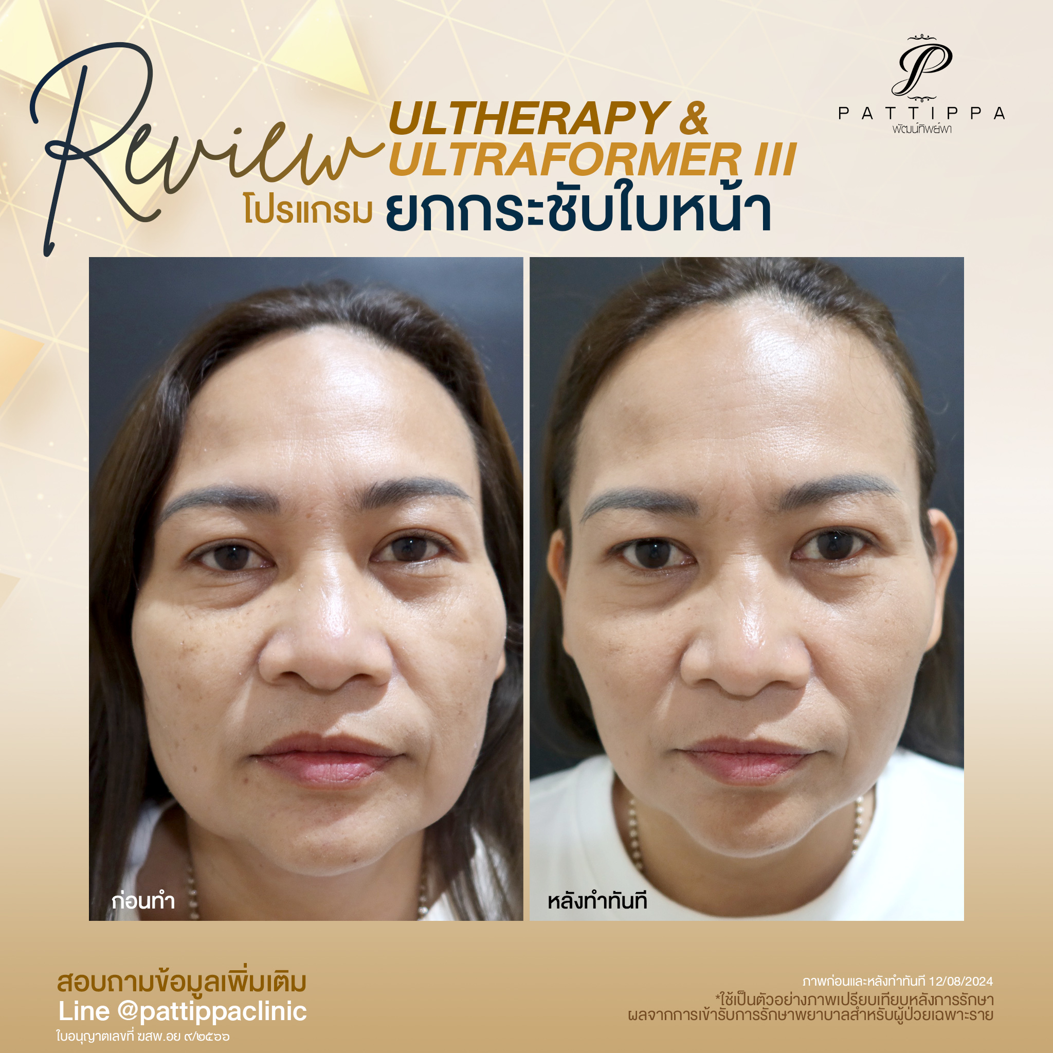 Patt_review_ultherapy+ultraformer3_002