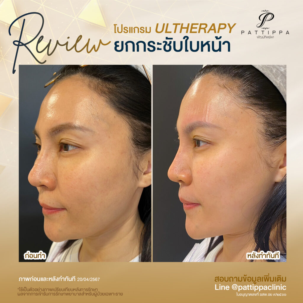 Pattippa Clinic Program Ulthera Thermaflx สิวฝ้า พิโคเลเซอร์ HIFU